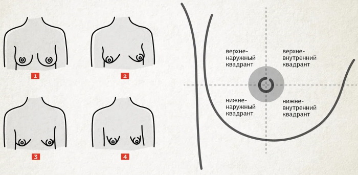 Tubular form of mammary glands, breasts. Photo, correction without surgery for women, men