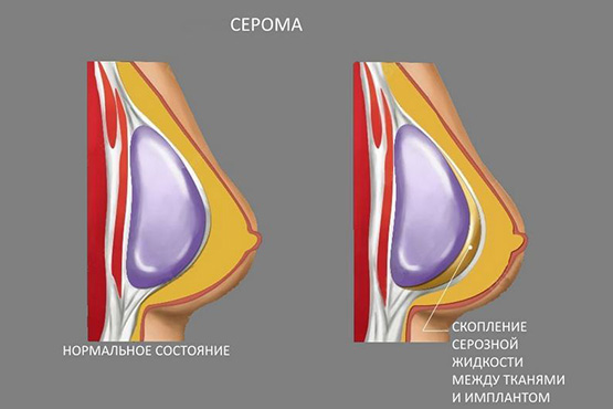 Forma tubulare di ghiandole mammarie, seno. Foto, correzione senza chirurgia per donne, uomini