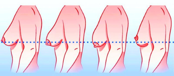 Tubular form of mammary glands, breasts. Photo, correction without surgery for women, men