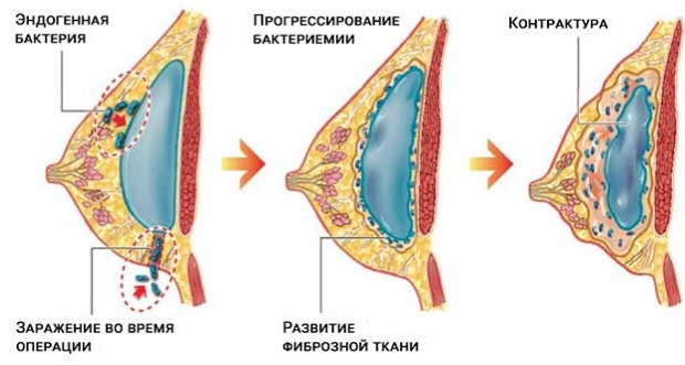 Tubular form of mammary glands, breasts. Photo, correction without surgery for women, men