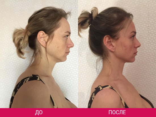 How to remove a double chin. Cosmetology without surgery: injections, threads, fillers, exercises, revitonics, rf lifting, lipolytics, Darsonval, teips and more