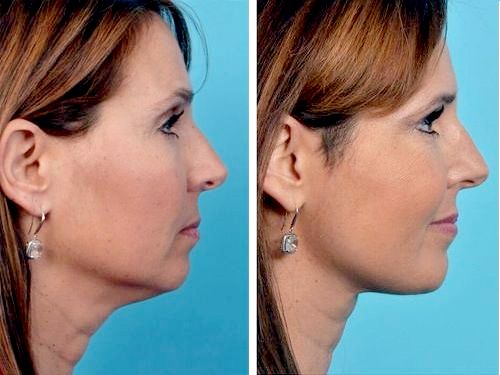 How to remove a double chin. Cosmetology without surgery: injections, threads, fillers, exercises, revitonics, rf lifting, lipolytics, Darsonval, teips and more