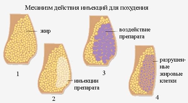 Reduction of the nose with lipolytics. Before and after photos, price, reviews, consequences