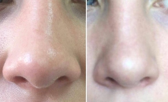 Reduction of the nose with lipolytics. Before and after photos, price, reviews, consequences