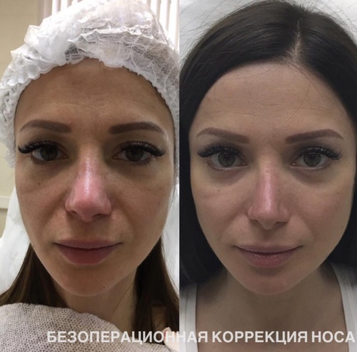 Reduction of the nose with lipolytics. Before and after photos, price, reviews, consequences