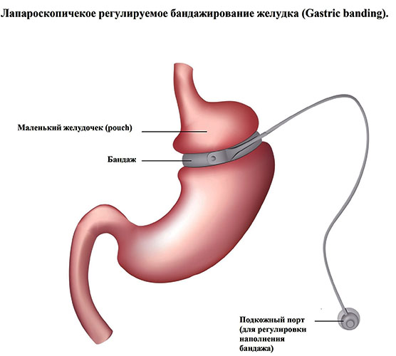 Extreme weight loss by 5-10 kg in a week at home