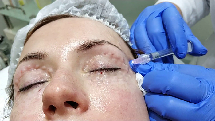 How to get rid of wrinkles under the eyes. Cosmetology