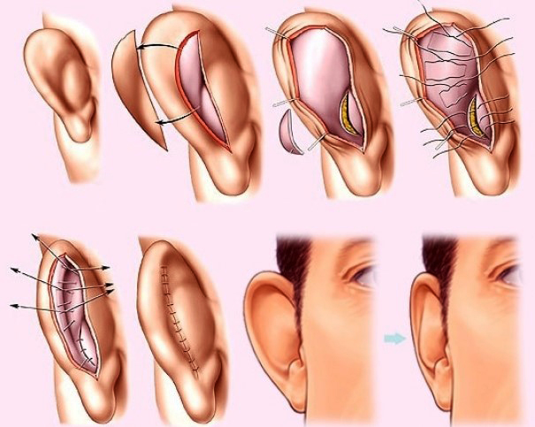 Chirurgia dell'orecchio per le orecchie cadenti. Quanto costa