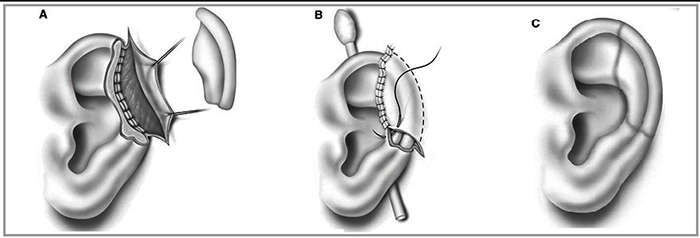 Ear surgery for lop-earedness. What is the price