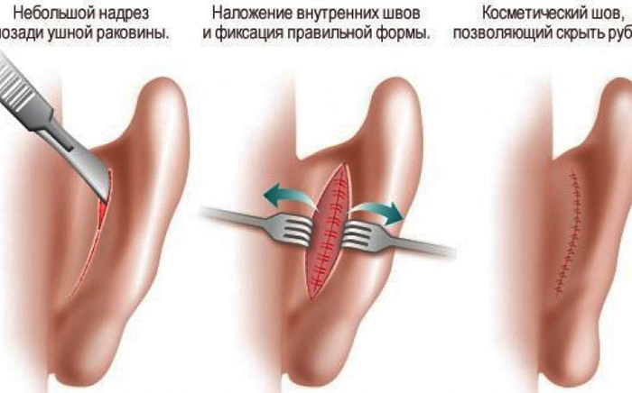 Ear surgery for lop-earedness. What is the price