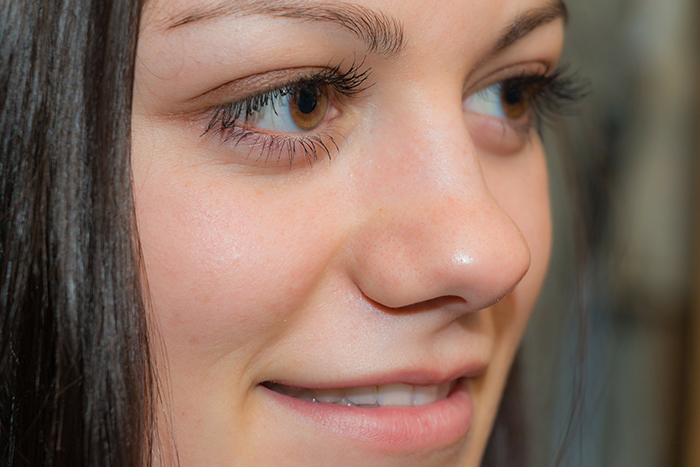 Girls have a wide nose. What to do, how to get rid of, rhinoplasty