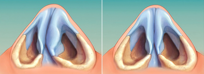 Girls have a wide nose. What to do, how to get rid of, rhinoplasty