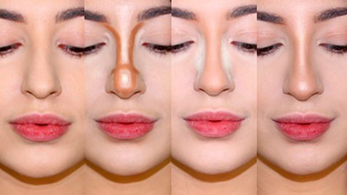 Girls have a wide nose. What to do, how to get rid of, rhinoplasty