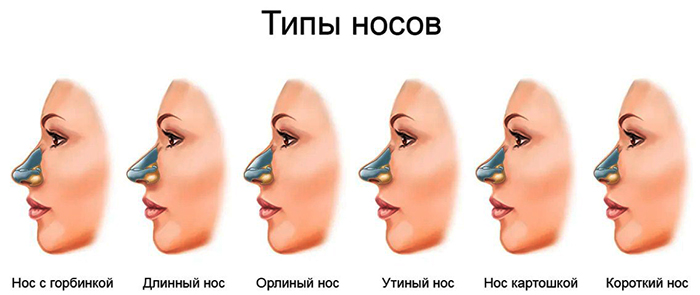 Girls have a wide nose. What to do, how to get rid of, rhinoplasty