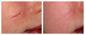 Laser scar removal on the face. Reviews, before and after photos, price