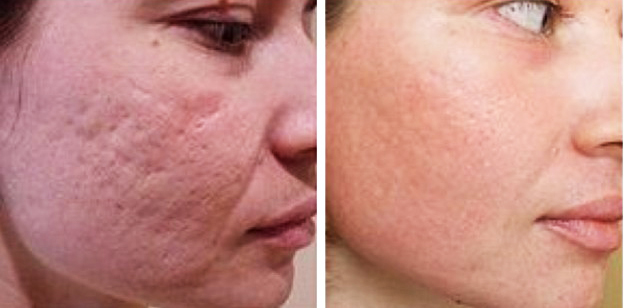 Laser scar removal on the face. Reviews, before and after photos, price