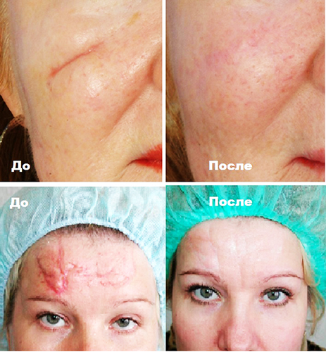 Laser scar removal on the face. Reviews, before and after photos, price