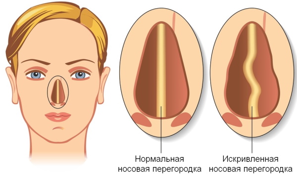 The girl has a big nose. Photos before and after rhinoplasty