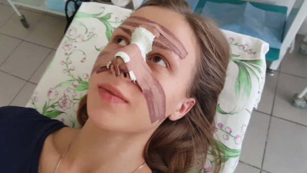 The girl has a big nose. Photos before and after rhinoplasty