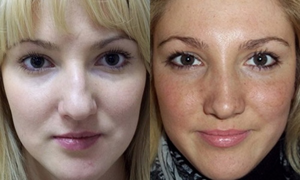 The girl has a big nose. Photos before and after rhinoplasty