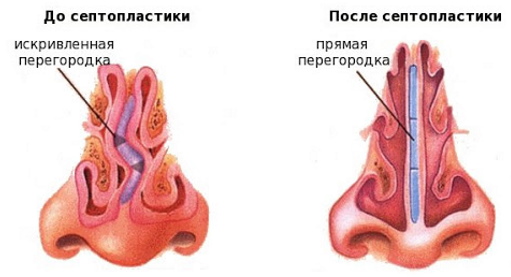 The girl has a big nose. Photos before and after rhinoplasty