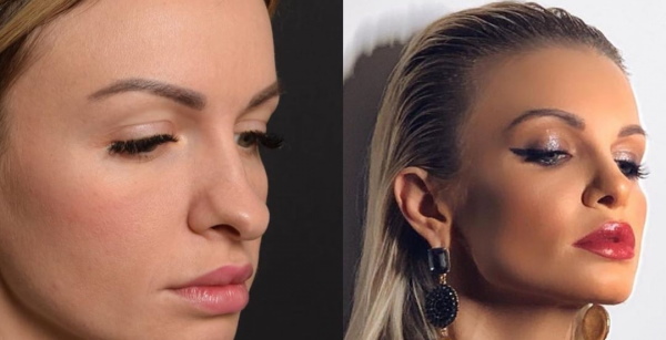 The girl has a long nose. Photos before and after rhinoplasty