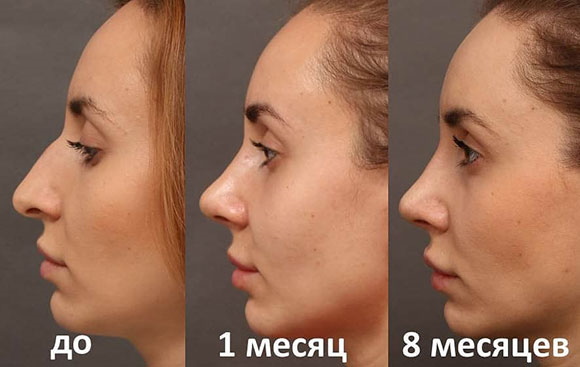 The girl has a long nose. Photos before and after rhinoplasty