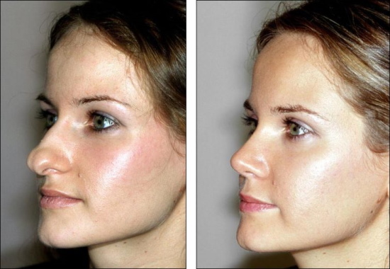 The girl has a long nose. Photos before and after rhinoplasty