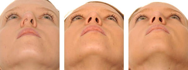 The girl has a long nose. Photos before and after rhinoplasty