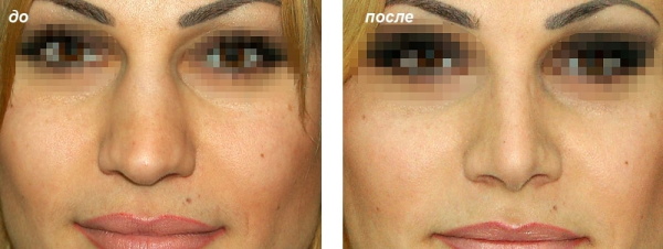 The girl has a long nose. Photos before and after rhinoplasty