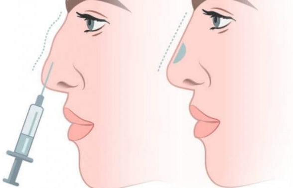 The girl has a long nose.Photos before and after rhinoplasty