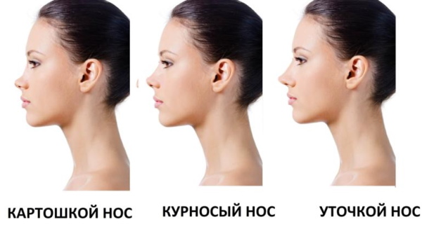 The girl has a snub nose. How to fix before and after photos of rhinoplasty