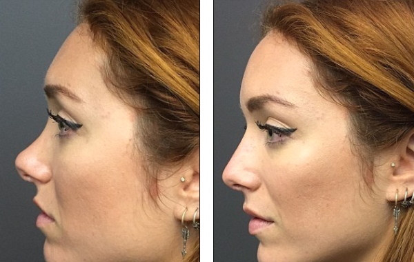 The girl has a snub nose. How to fix before and after photos of rhinoplasty