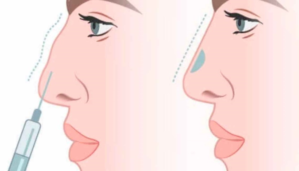 The girl has a snub nose. How to fix before and after photos of rhinoplasty