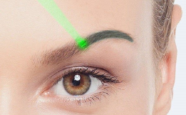 Laser removal of permanent makeup (tattooing) of eyebrows, lips, eyelids