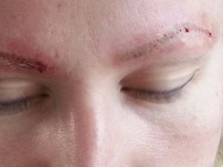 Laser removal of permanent makeup (tattooing) of eyebrows, lips, eyelids