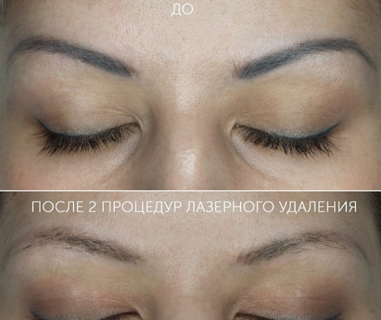 Laser removal of permanent makeup (tattooing) of eyebrows, lips, eyelids