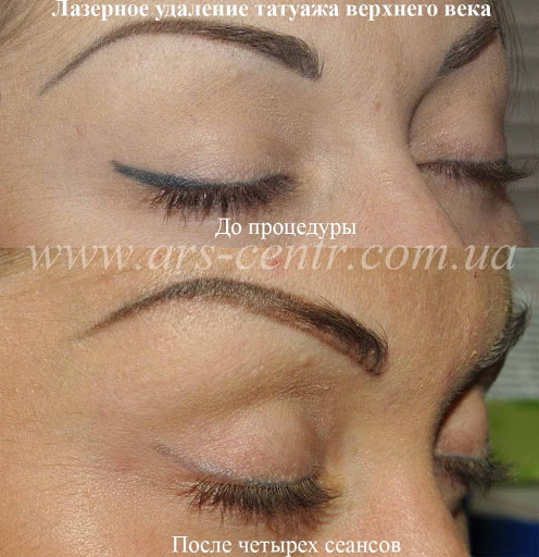 Laser removal of permanent makeup (tattooing) of eyebrows, lips, eyelids