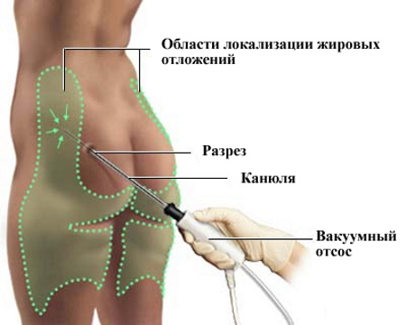 Liposuzione dell'interno coscia. Foto prima e dopo, prezzo