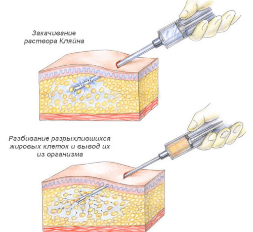 Liposuction of the inner thigh. Before and after photos, price