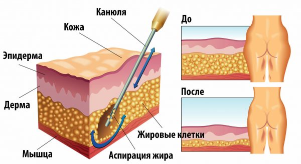 Liposuction of the inner thigh. Before and after photos, price