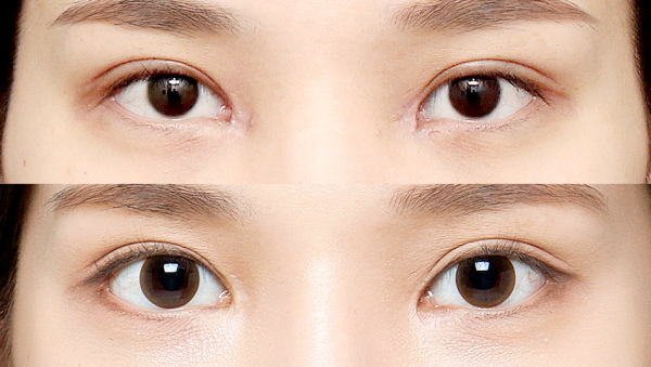 Girls have small eyes. How to increase the price of plastic surgery