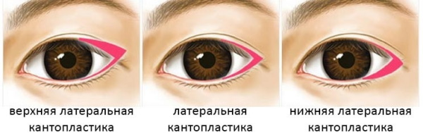 Girls have small eyes. How to increase the price of plastic surgery