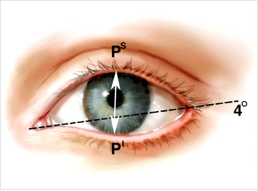 Girls have small eyes. How to increase the price of plastic surgery