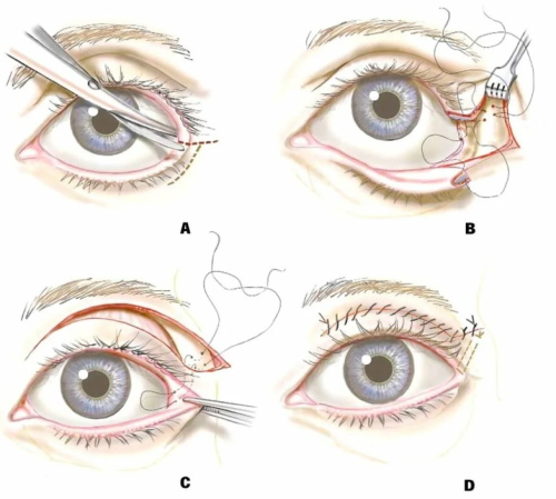 Girls have small eyes. How to increase the price of plastic surgery