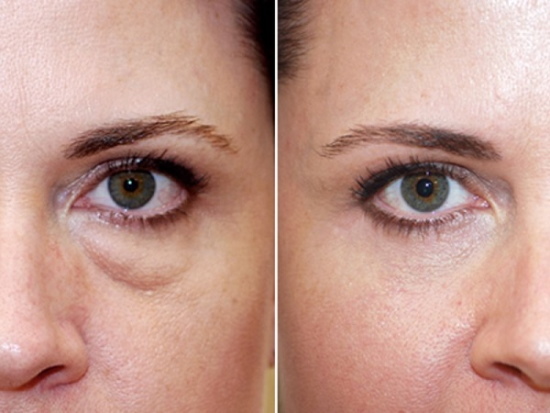 Bags under the eyes: cosmetic procedures, injections. Reviews