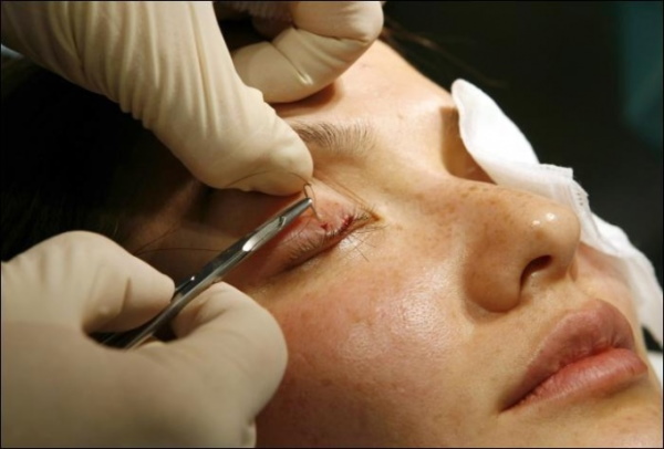 Plastic surgery on the eyelids. Before and after photos, price, reviews