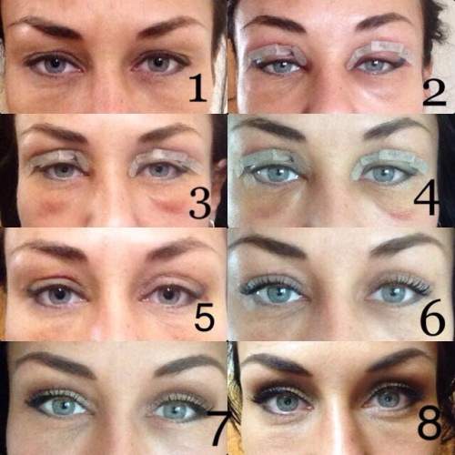 Plastic surgery on the eyelids. Before and after photos, price, reviews