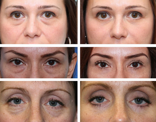 Plastic surgery on the eyelids. Before and after photos, price, reviews