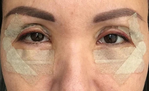 Plastic surgery on the eyelids. Before and after photos, price, reviews